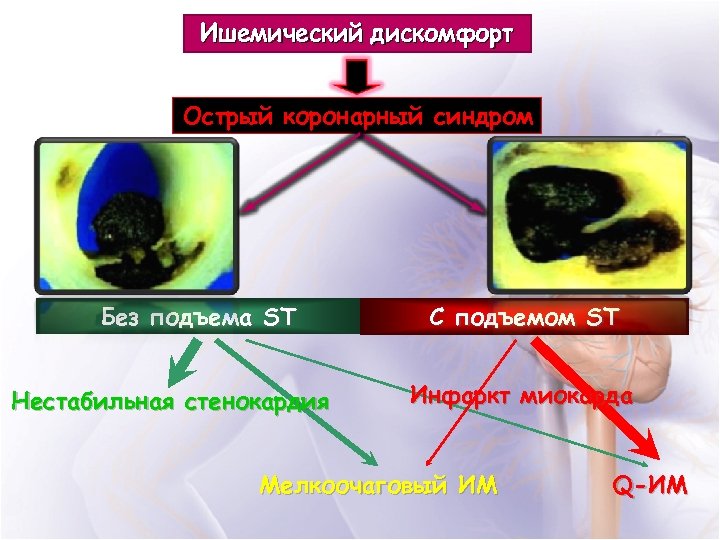 Ишемический дискомфорт Острый коронарный синдром Без подъема ST Нестабильная стенокардия C подъемом ST Инфаркт