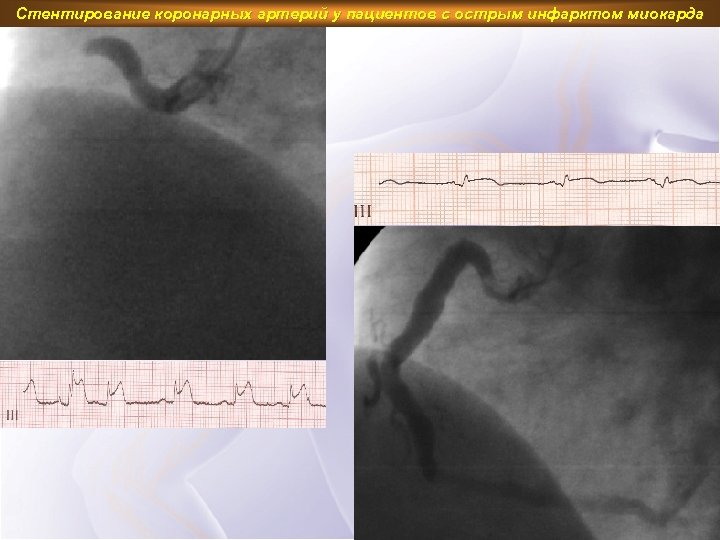 Стентирование коронарных артерий у пациентов с острым инфарктом миокарда 