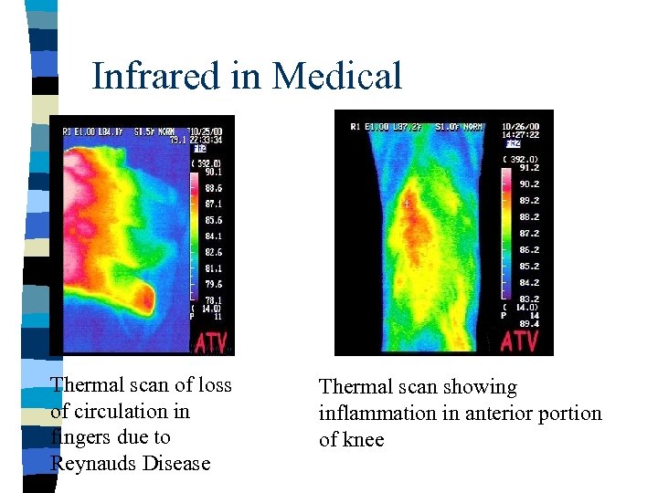 Infrared in Medical Thermal scan of loss of circulation in fingers due to Reynauds