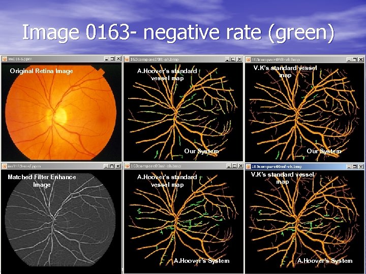Image 0163 - negative rate (green) Original Retina Image A. Hoover’s standard vessel map