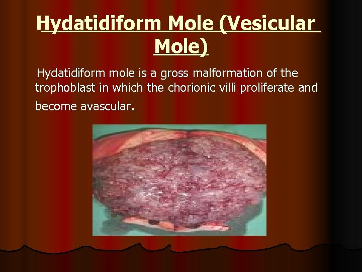 Hydatidiform Mole (Vesicular Mole) Hydatidiform mole is a gross malformation of the trophoblast in