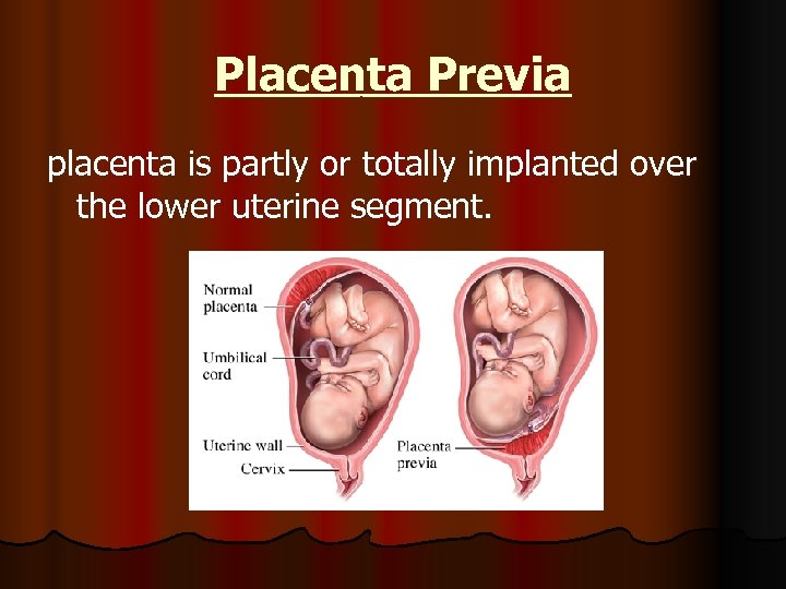 Placenta Previa placenta is partly or totally implanted over the lower uterine segment. 