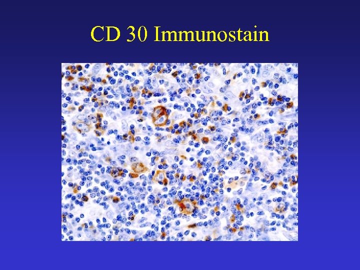 CD 30 Immunostain 