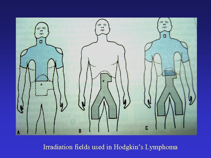 Irradiation fields used in Hodgkin’s Lymphoma 