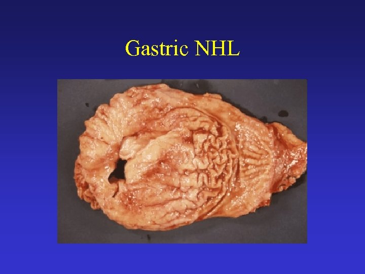 Gastric NHL 