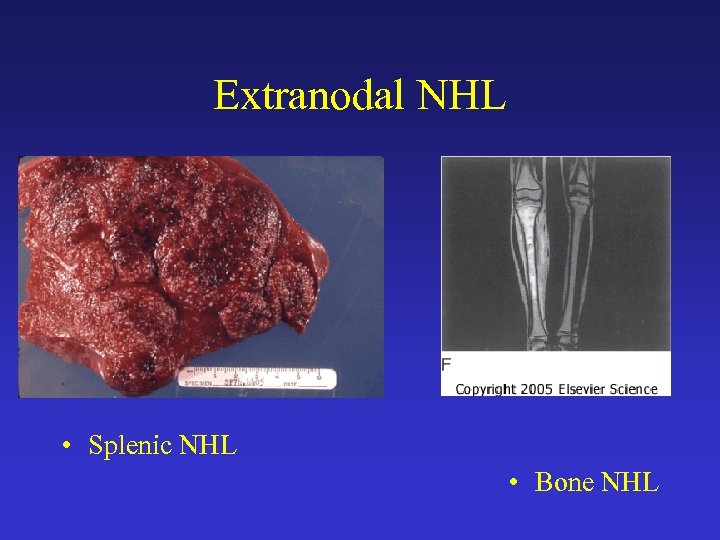 Extranodal NHL • Splenic NHL • Bone NHL 