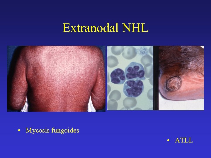 Extranodal NHL • Mycosis fungoides • ATLL 