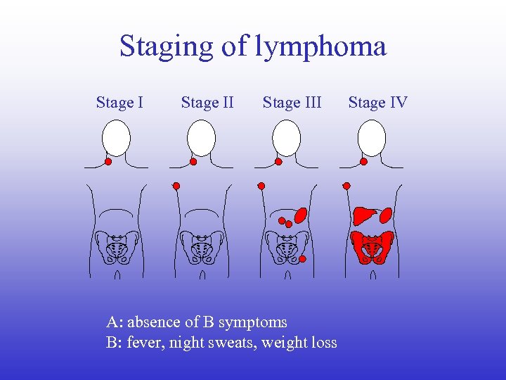 Staging of lymphoma Stage III A: absence of B symptoms B: fever, night sweats,