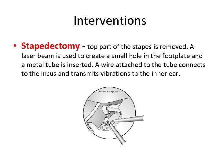 Interventions • Stapedectomy - top part of the stapes is removed. A laser beam