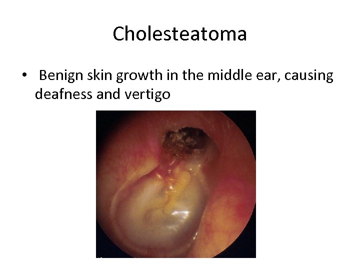 Cholesteatoma • Benign skin growth in the middle ear, causing deafness and vertigo 