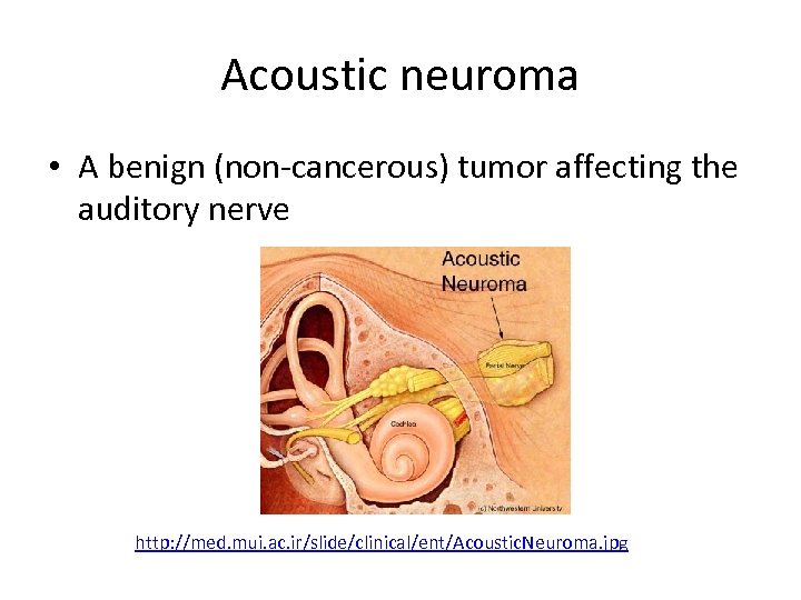 Acoustic neuroma • A benign (non-cancerous) tumor affecting the auditory nerve http: //med. mui.