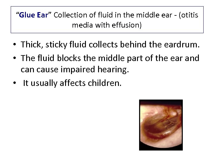 “Glue Ear” Collection of fluid in the middle ear - (otitis media with effusion)