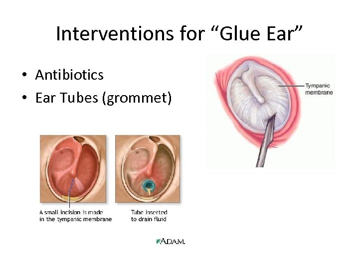 Interventions for “Glue Ear” • Antibiotics • Ear Tubes (grommet) 