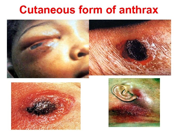 Cutaneous form of anthrax 