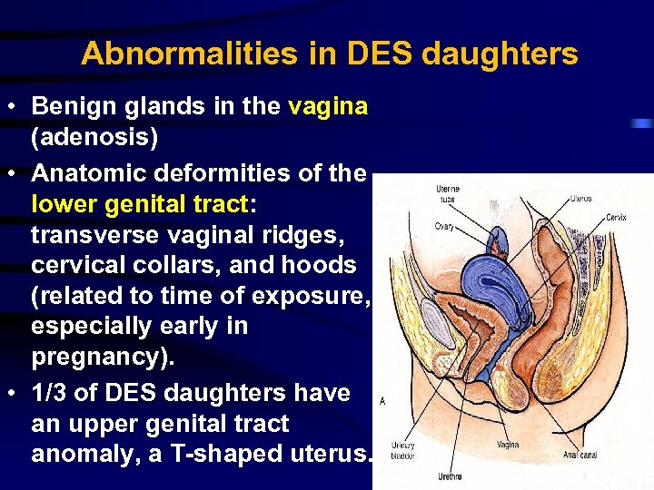 Abnormalities in DES daughters • Benign glands in the vagina (adenosis) • Anatomic deformities