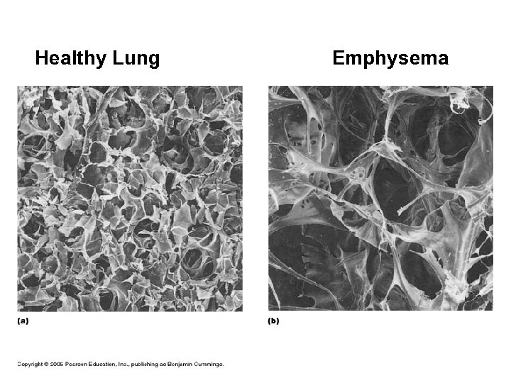 Healthy Lung Copyright © 2007 Pearson Education, Inc. , publishing as Benjamin Cummings Emphysema