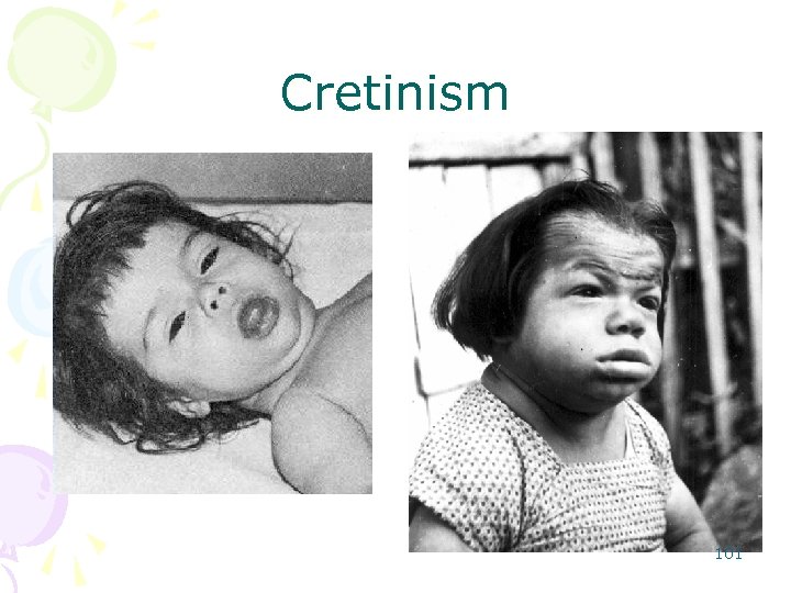 Cretinism 101 