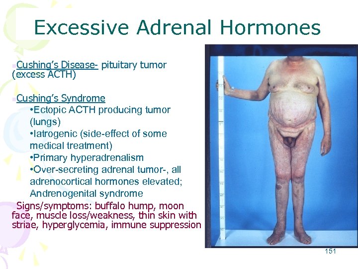 Excessive Adrenal Hormones Cushing’s Disease- pituitary tumor (excess ACTH) n Cushing’s Syndrome • Ectopic