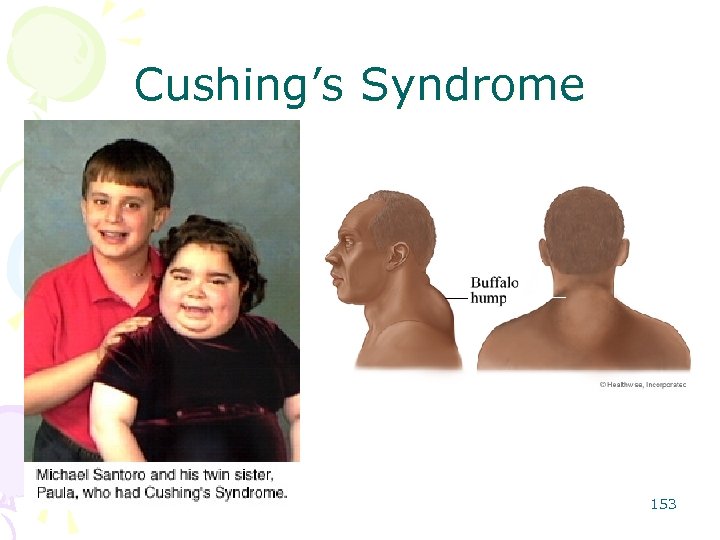 Cushing’s Syndrome 153 