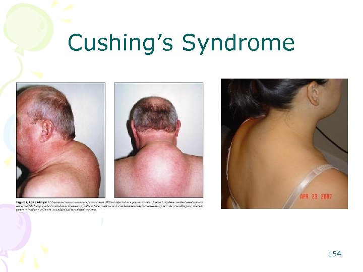 Cushing’s Syndrome 154 