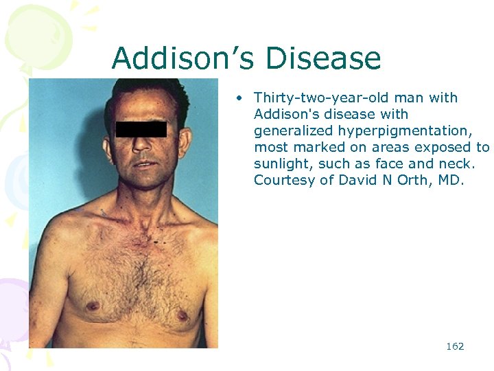 Addison’s Disease • Thirty-two-year-old man with Addison's disease with generalized hyperpigmentation, most marked on