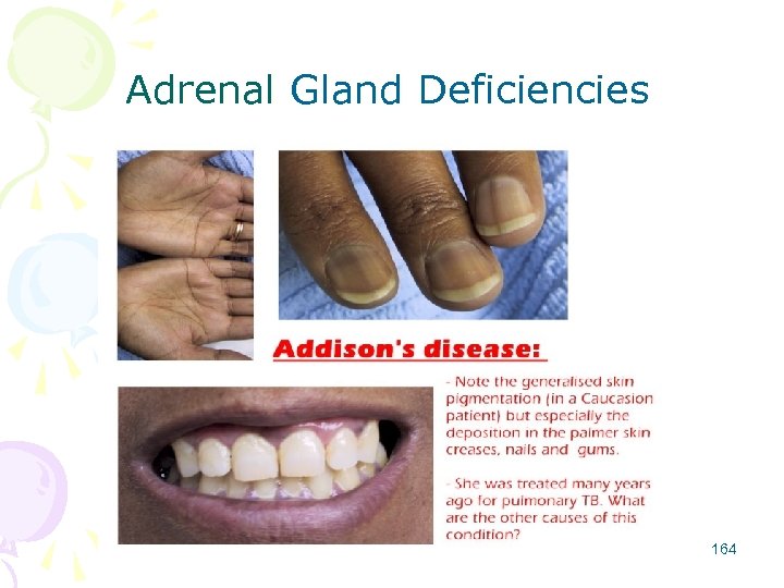 Adrenal Gland Deficiencies 164 