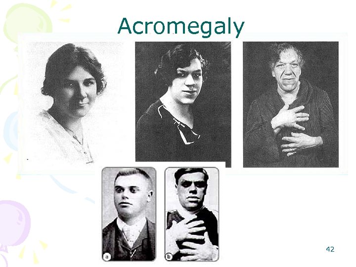 Acromegaly 42 