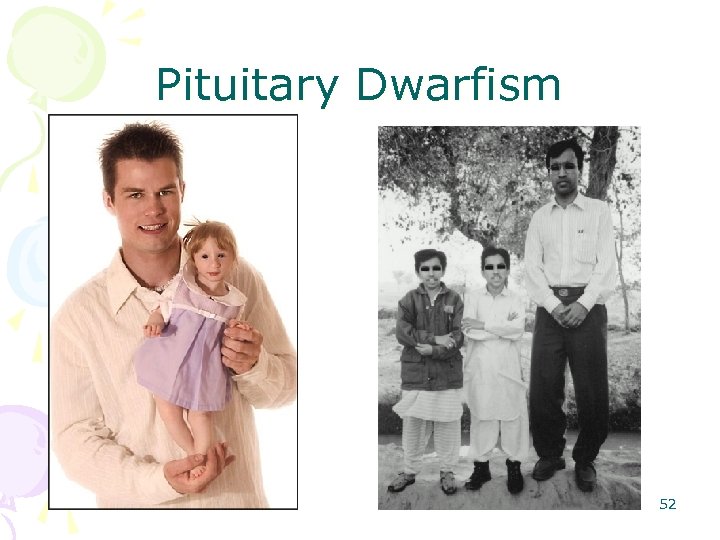 Pituitary Dwarfism 52 