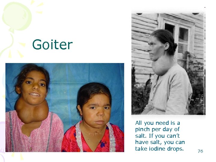 Goiter All you need is a pinch per day of salt. If you can’t