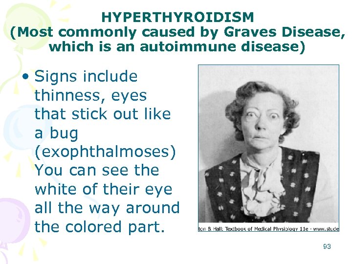 HYPERTHYROIDISM (Most commonly caused by Graves Disease, which is an autoimmune disease) • Signs