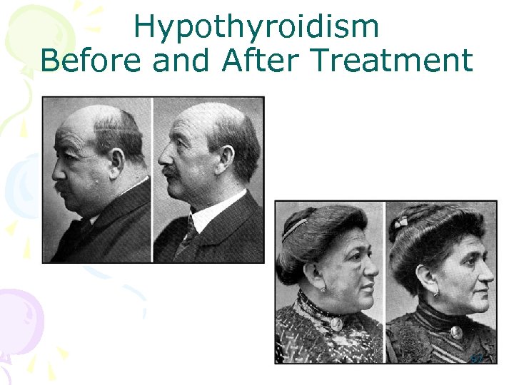 Hypothyroidism Before and After Treatment 97 