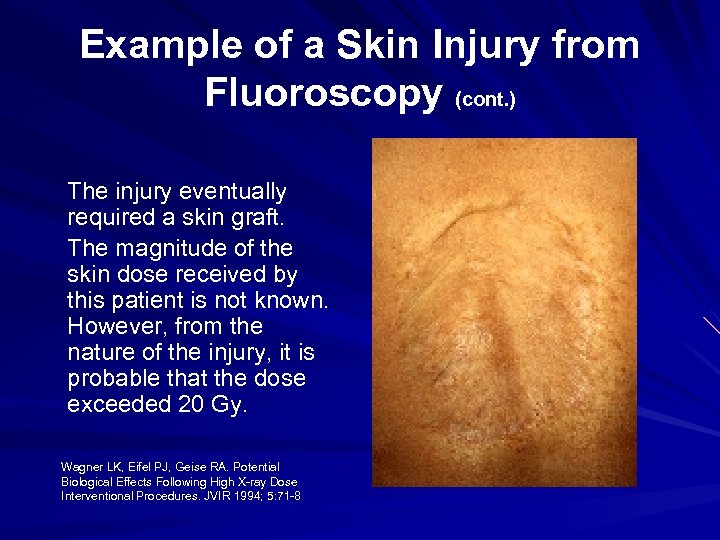 Example of a Skin Injury from Fluoroscopy (cont. ) The injury eventually required a