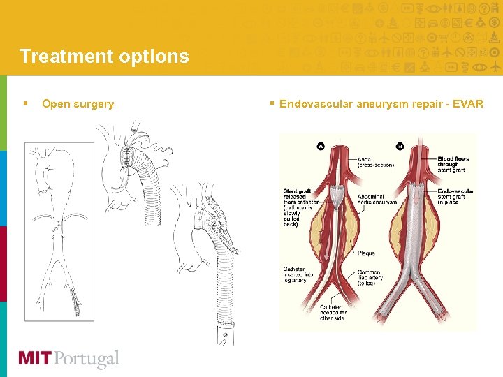 Treatment options § Open surgery § Endovascular aneurysm repair - EVAR 