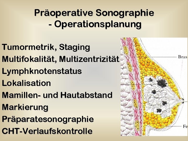 Präoperative Sonographie - Operationsplanung Tumormetrik, Staging Multifokalität, Multizentrizität Lymphknotenstatus Lokalisation Mamillen- und Hautabstand Markierung