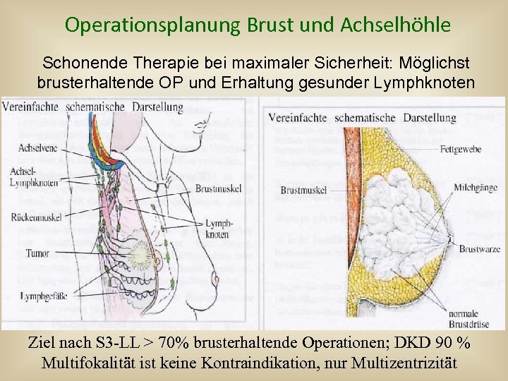 Operationsplanung Brust und Achselhöhle Schonende Therapie bei maximaler Sicherheit: Möglichst brusterhaltende OP und Erhaltung