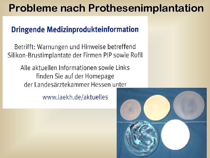 Probleme nach Prothesenimplantation 56 