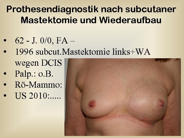 Prothesendiagnostik nach subcutaner Mastektomie und Wiederaufbau • 62 - J. 0/0, FA – •