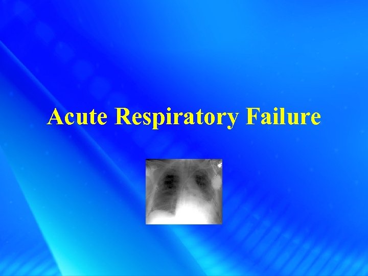 Acute Respiratory Failure 