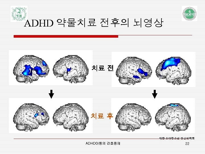 ADHD 약물치료 전후의 뇌영상 치료 전 남/10 치료 후 대한 소아청소년 정신의학회 ADHD아동의 간호중재