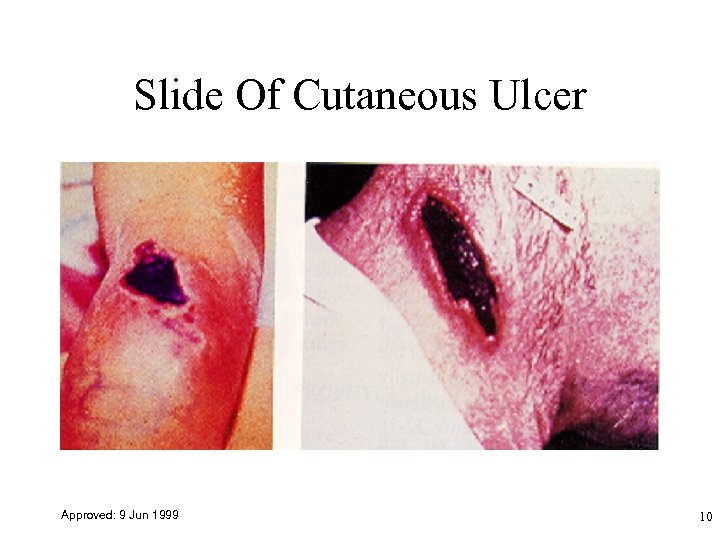 Slide Of Cutaneous Ulcer Approved: 9 Jun 1999 10 