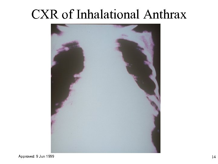 CXR of Inhalational Anthrax Approved: 9 Jun 1999 14 