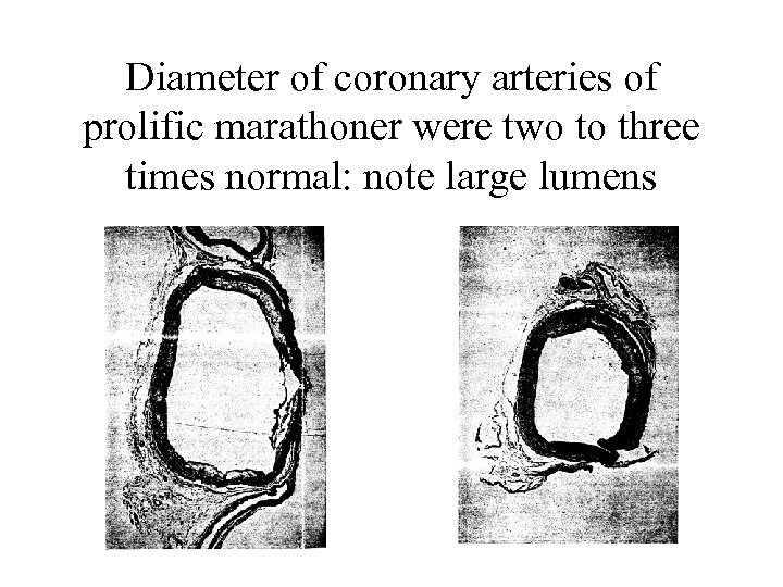 Diameter of coronary arteries of prolific marathoner were two to three times normal: note