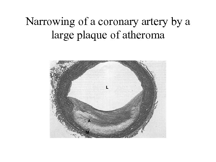 Narrowing of a coronary artery by a large plaque of atheroma 