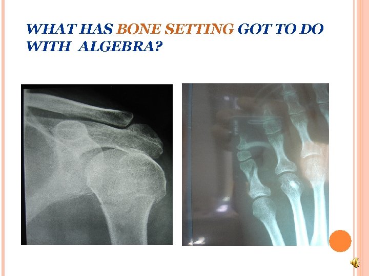 WHAT HAS BONE SETTING GOT TO DO WITH ALGEBRA? 