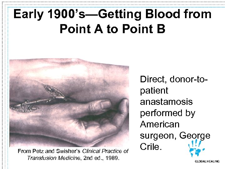 Early 1900’s—Getting Blood from Point A to Point B From Petz and Swisher’s Clinical