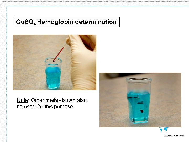 Cu. SO 4 Hemoglobin determination Note: Other methods can also be used for this