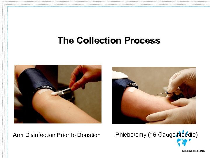 The Collection Process Arm Disinfection Prior to Donation Phlebotomy (16 Gauge Needle) 
