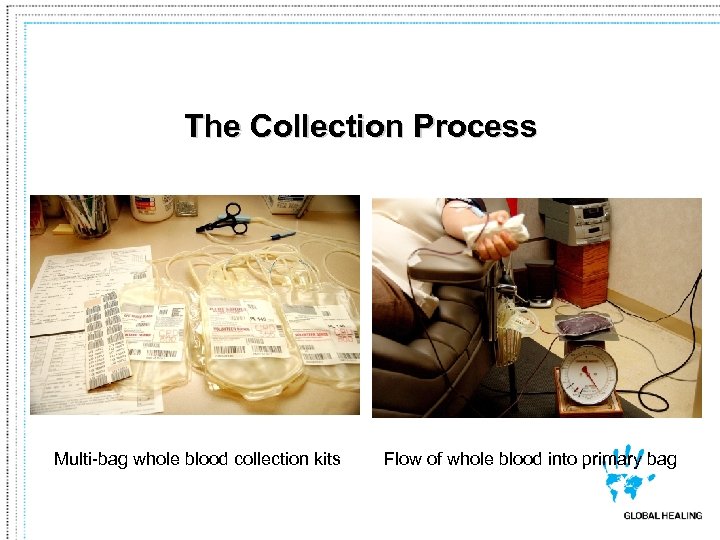 The Collection Process Multi-bag whole blood collection kits Flow of whole blood into primary