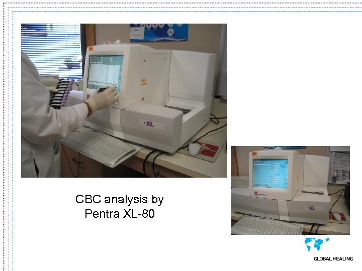 CBC analysis by Pentra XL-80 