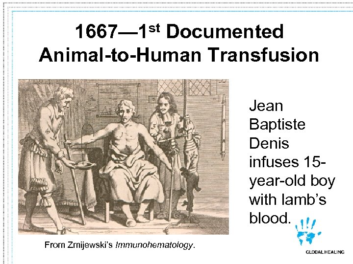 1667— 1 st Documented Animal-to-Human Transfusion Jean Baptiste Denis infuses 15 year-old boy with